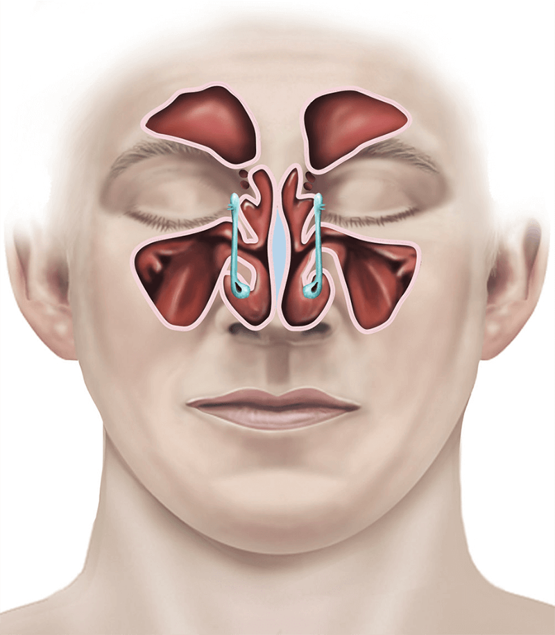 Breathing Easy: A Comprehensive Guide to Blocked Nose Surgery