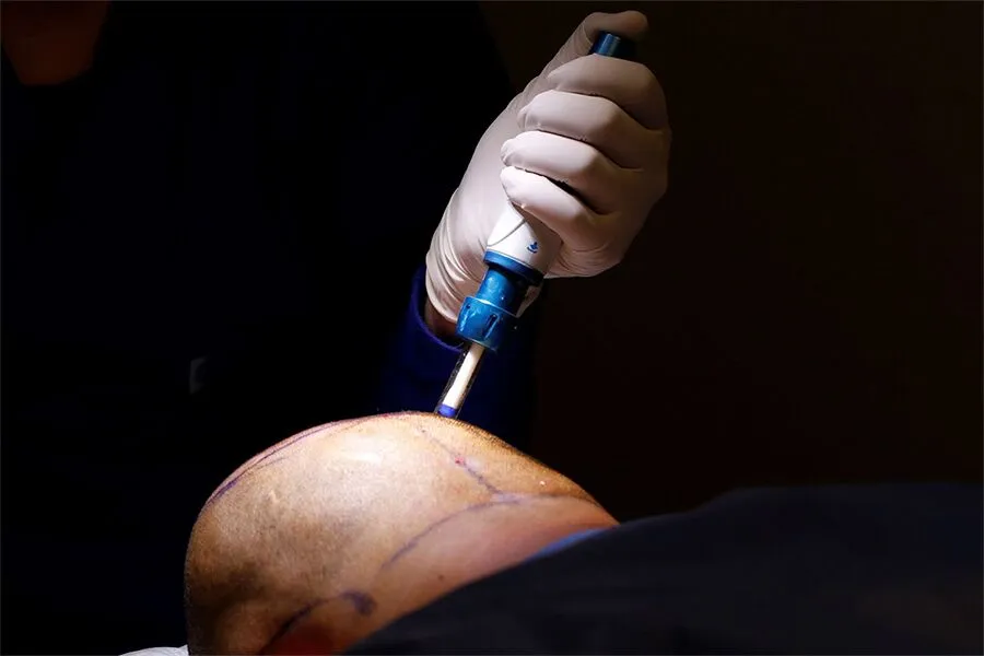 Anesthesia Protocols in Modern Hair Surgery