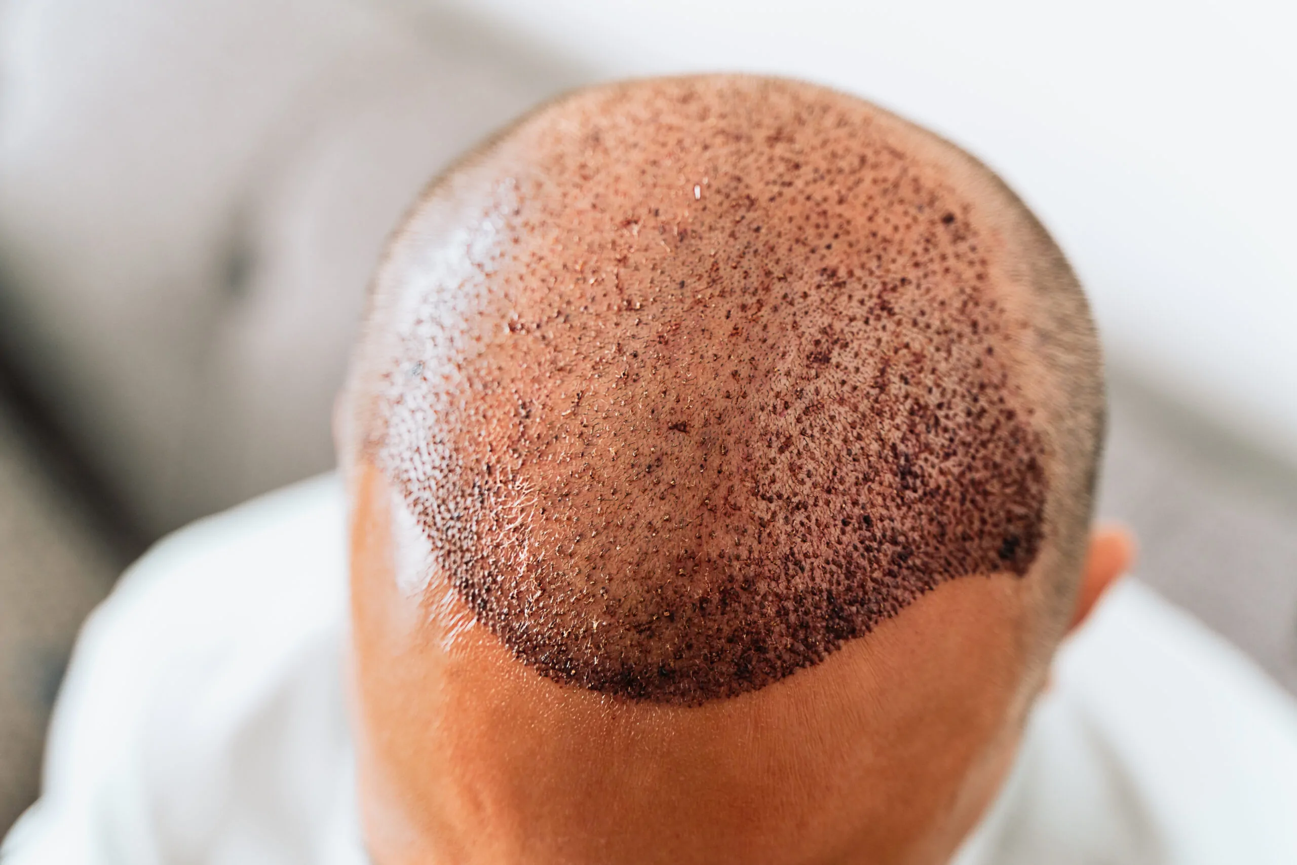 Functional Medicine and Hair Transplantation: A Holistic Strategy for Lasting Results