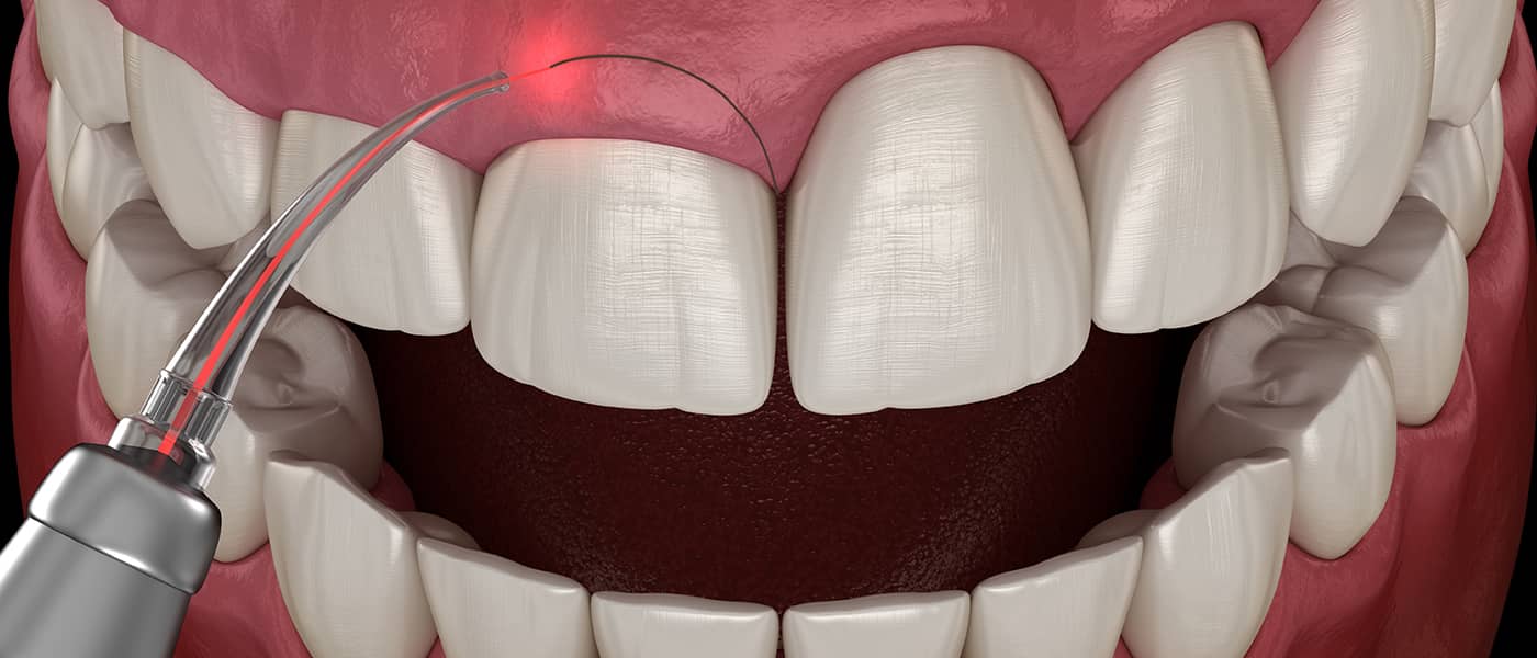 When Is Surgical Periodontics Necessary?